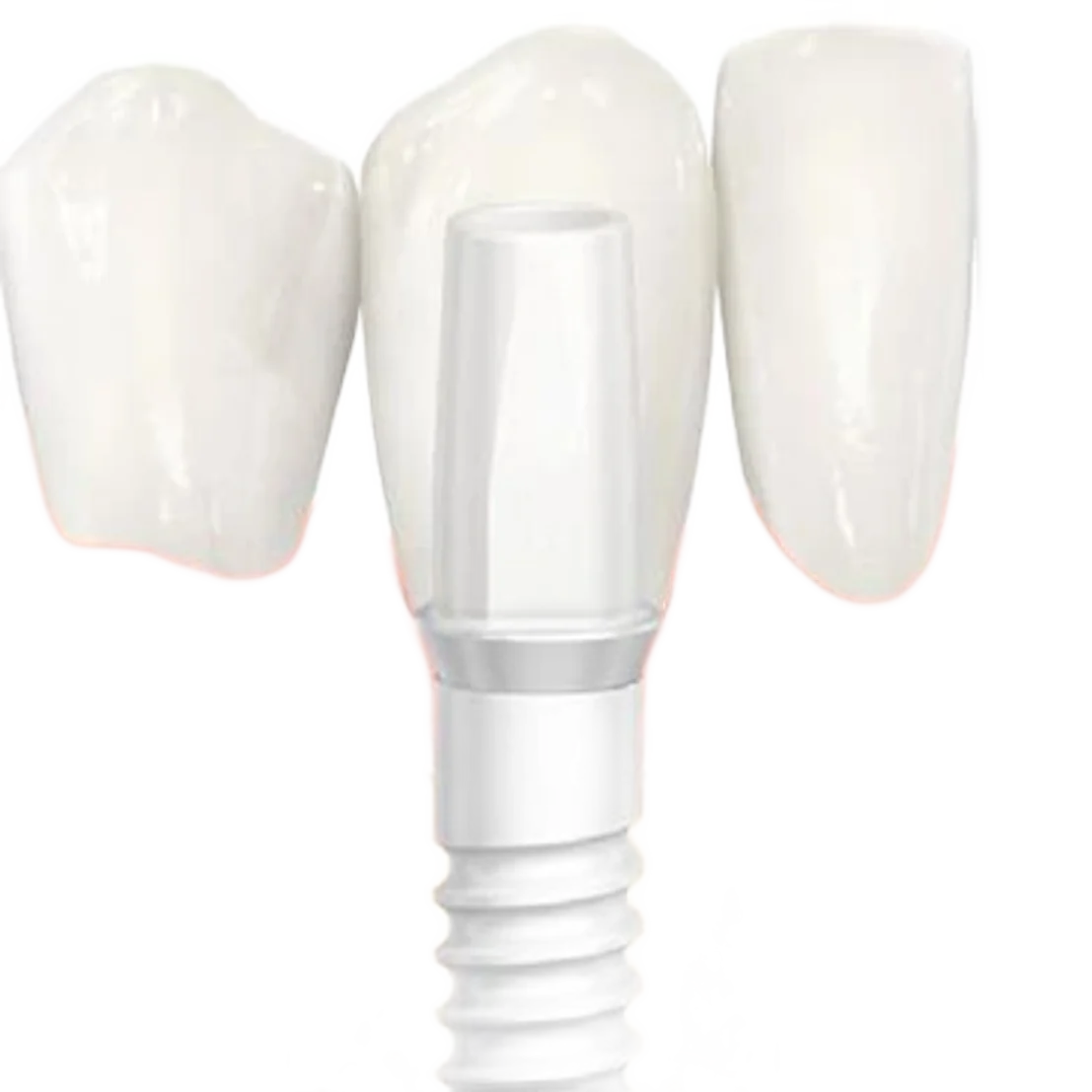 Illustration en coupe d’un implant dentaire vissé dans l’os de la mâchoire, entouré de gencive rose et de dents blanches.